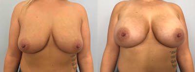 Breast Augmentation Before & After Gallery - Patient 142926641 - Image 1