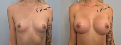 Breast Augmentation Before & After Gallery - Patient 142926659 - Image 1