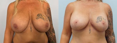 Breast Revision Before & After Gallery - Patient 142927127 - Image 1