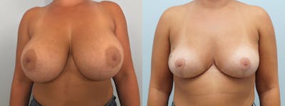 Implant Removal Before & After Gallery - Patient 142927137 - Image 1