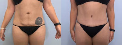 Tummy Tuck Before & After Gallery - Patient 142927152 - Image 1