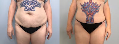 Tummy Tuck Before & After Gallery - Patient 142927151 - Image 1