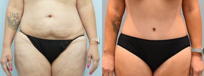 Body Lift Before & After Gallery - Patient 144236637 - Image 1