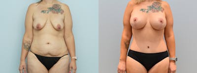 Mommy Makeover Before & After Gallery - Patient 144236995 - Image 1
