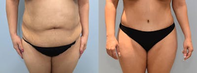 Tummy Tuck Before & After Gallery - Patient 144237127 - Image 1