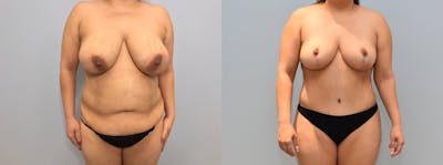 Mommy Makeover Before & After Gallery - Patient 144237366 - Image 1