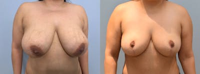 Breast Reduction Before & After Gallery - Patient 144237596 - Image 1