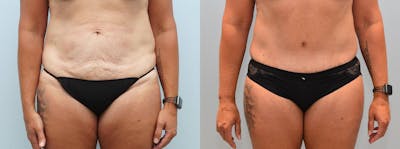 Tummy Tuck Before & After Gallery - Patient 144237942 - Image 1