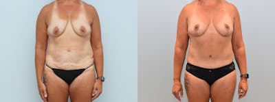 Mommy Makeover Before & After Gallery - Patient 144238006 - Image 1