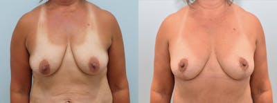 Breast Lift Before & After Gallery - Patient 144238073 - Image 1