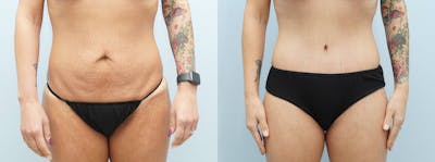 Tummy Tuck Before & After Gallery - Patient 144238083 - Image 1
