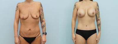 Mommy Makeover Before & After Gallery - Patient 144238086 - Image 1
