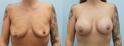 Breast Augmentation Before & After Gallery - Patient 144238144 - Image 1