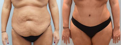Tummy Tuck Before & After Gallery - Patient 144238293 - Image 1