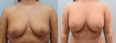 Breast Augmentation Before & After Gallery - Patient 144238373 - Image 1