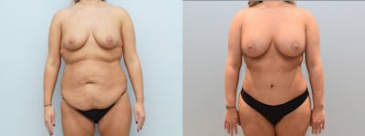 Mommy Makeover Before & After Gallery - Patient 144238300 - Image 1