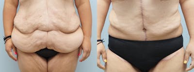 Body Lift Before & After Gallery - Patient 144268658 - Image 1
