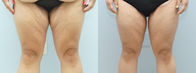 Thigh Lift Before & After Gallery - Patient 144268809 - Image 1