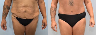 Body Lift Before & After Gallery - Patient 144269127 - Image 1