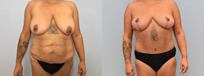 Mommy Makeover Before & After Gallery - Patient 144269163 - Image 1