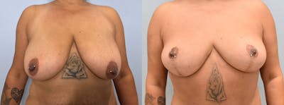 Breast Lift Before & After Gallery - Patient 144269503 - Image 1