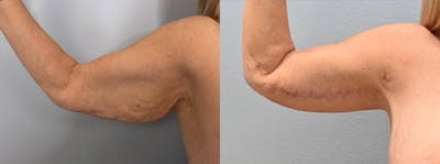 Arm Lift Before & After Gallery - Patient 144269576 - Image 1