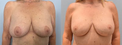 Breast Lift With Implants Before & After Gallery - Patient 144270810 - Image 1