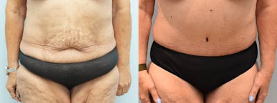 Tummy Tuck Before & After Gallery - Patient 144270840 - Image 1