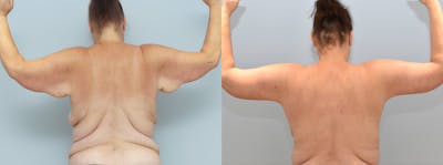 Arm Lift Before & After Gallery - Patient 144270872 - Image 1