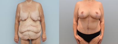 Mommy Makeover Before & After Gallery - Patient 144290062 - Image 1