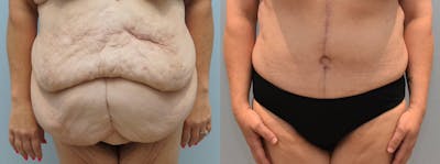 Tummy Tuck Before & After Gallery - Patient 144290174 - Image 1