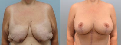 Breast Lift With Implants Before & After Gallery - Patient 144291721 - Image 1