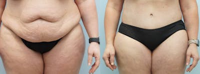 Body Lift Before & After Gallery - Patient 144291857 - Image 1