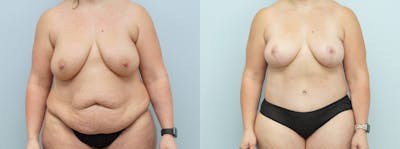 Mommy Makeover Before & After Gallery - Patient 144291922 - Image 1