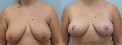 Breast Lift Before & After Gallery - Patient 144292061 - Image 1