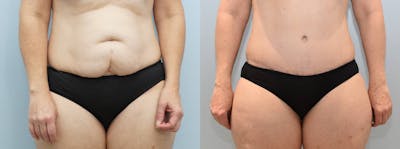 Tummy Tuck Before & After Gallery - Patient 144292726 - Image 1