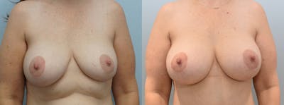 Breast Revision Before & After Gallery - Patient 144292823 - Image 1