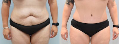 Tummy Tuck Before & After Gallery - Patient 144310352 - Image 1