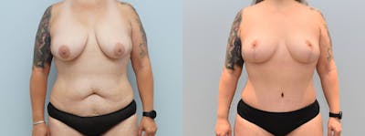Mommy Makeover Before & After Gallery - Patient 144310382 - Image 1