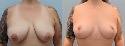 Breast Lift Before & After Gallery - Patient 144310401 - Image 1