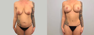 Mommy Makeover Before & After Gallery - Patient 144310439 - Image 1
