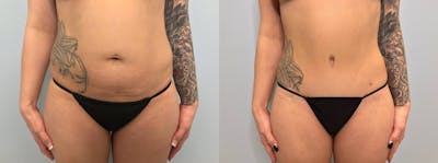 Body Lift Before & After Gallery - Patient 144310449 - Image 1
