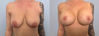 Breast Lift With Implants Before & After Gallery - Patient 144310869 - Image 1
