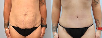 Tummy Tuck Before & After Gallery - Patient 144313119 - Image 1