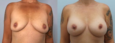 Breast Augmentation Before & After Gallery - Patient 144313606 - Image 1