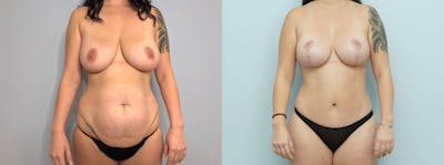 Mommy Makeover Before & After Gallery - Patient 144314086 - Image 1
