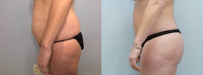 Brazilian Butt Lift Before & After Gallery - Patient 144314090 - Image 1
