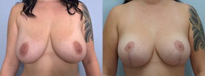 Breast Lift Before & After Gallery - Patient 144314120 - Image 1