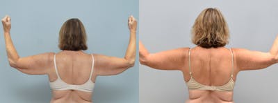 Arm Lift Before & After Gallery - Patient 144314148 - Image 1