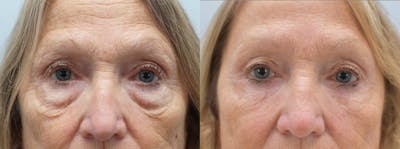 Eyelid Surgery Before & After Gallery - Patient 144314158 - Image 1